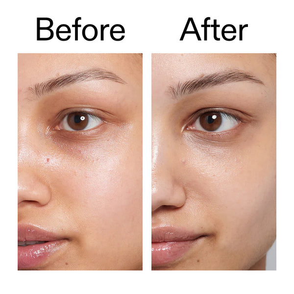 Before and after results around the eye area